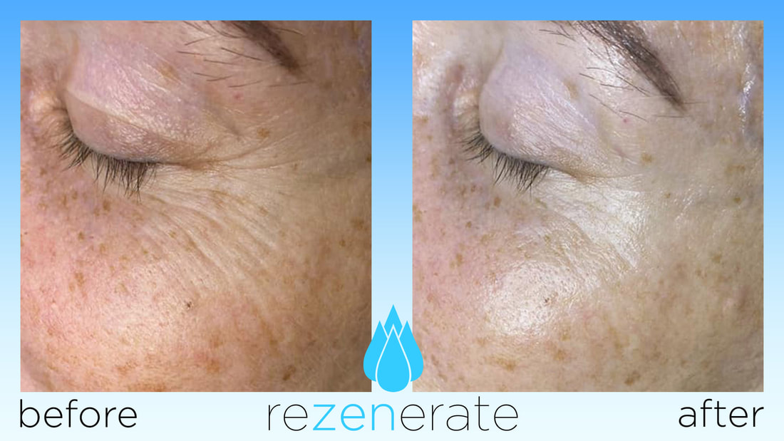 rezenerate facial after results